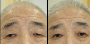 世田谷下北沢眼瞼下垂手術症例