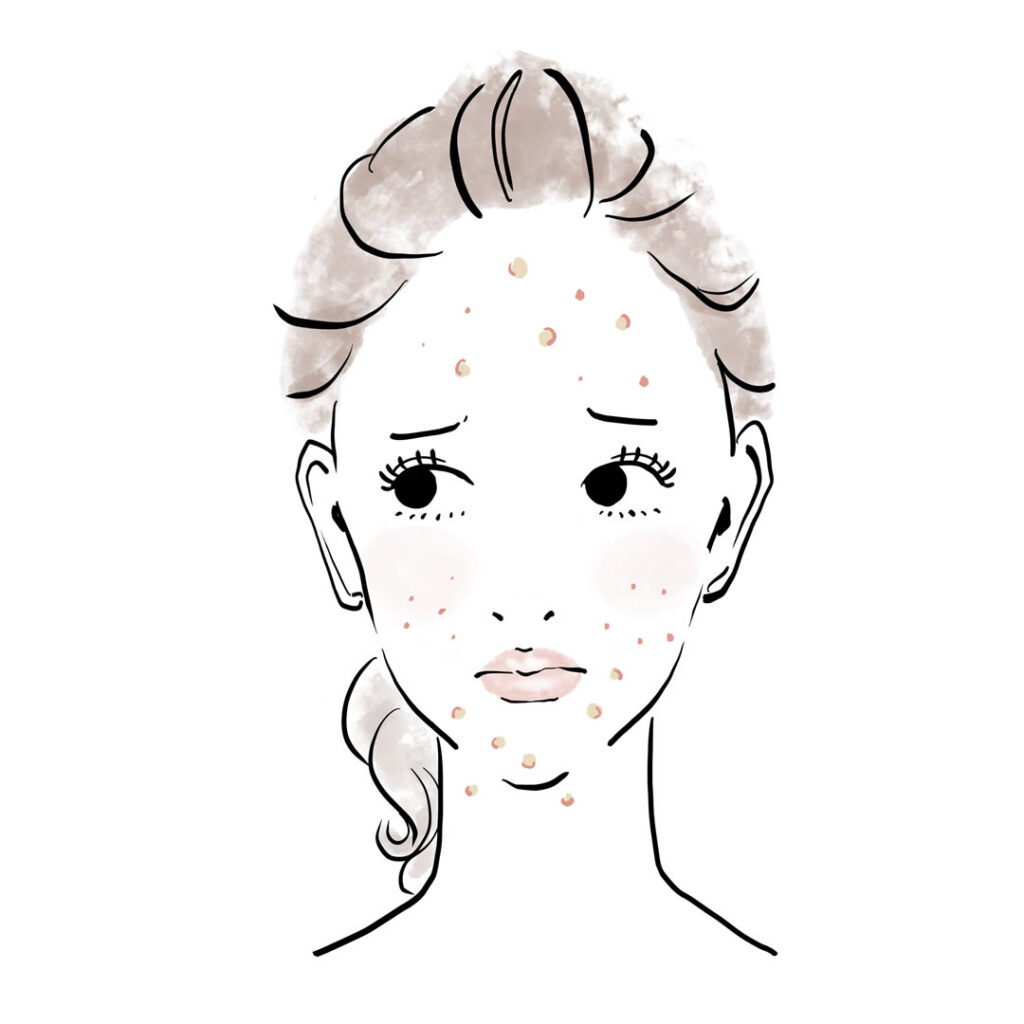 ニキビ跡に悩む女性