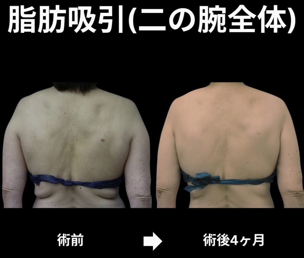 二の腕の脂肪吸引症例