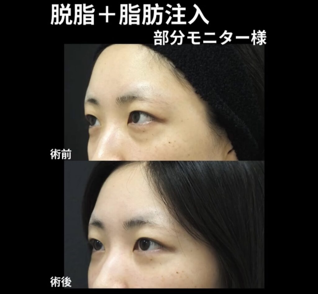 経結膜的脱脂術、脂肪注入(目の下)