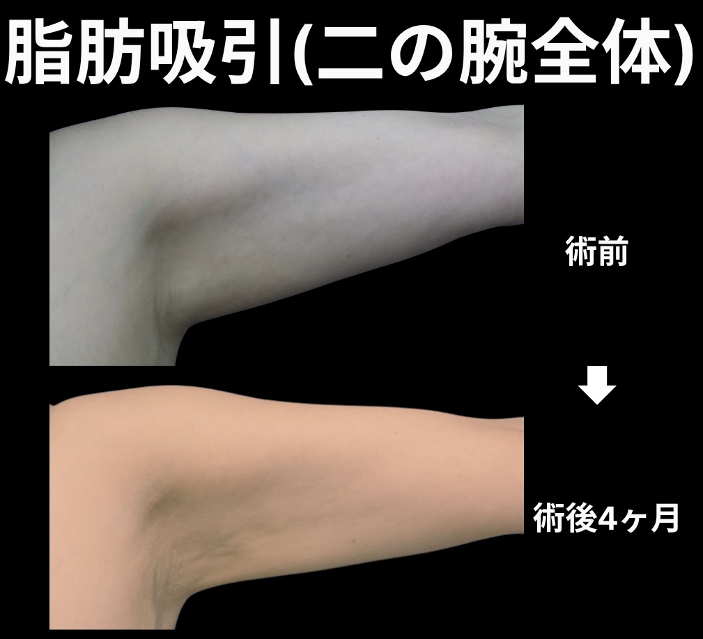 二の腕の脂肪吸引症例