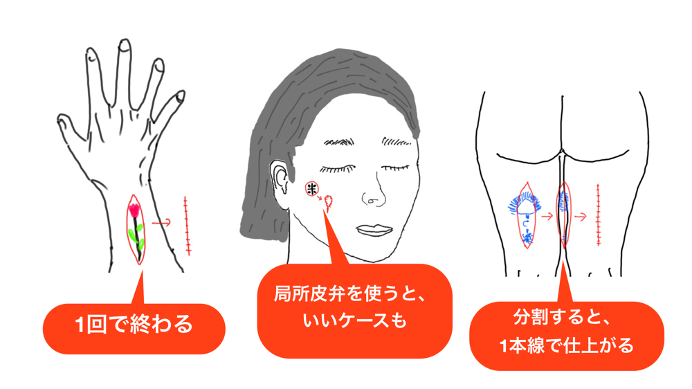 タトゥーの切除縫合法。局所皮弁や分割切除を併用することもあります。