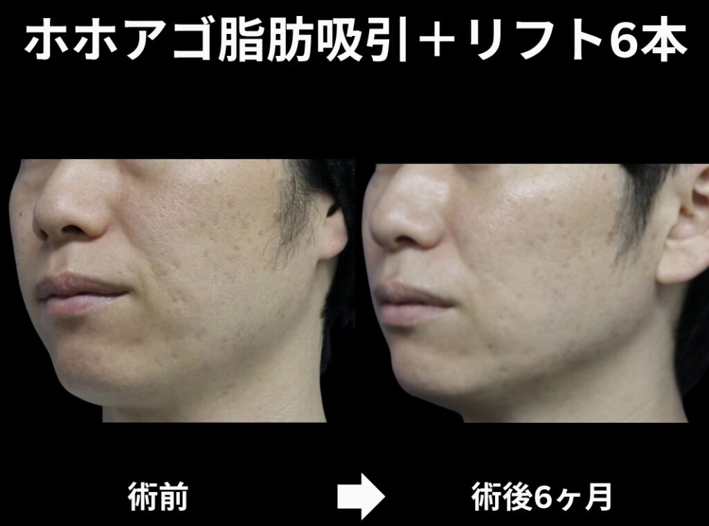 サクションリフトの症例写真