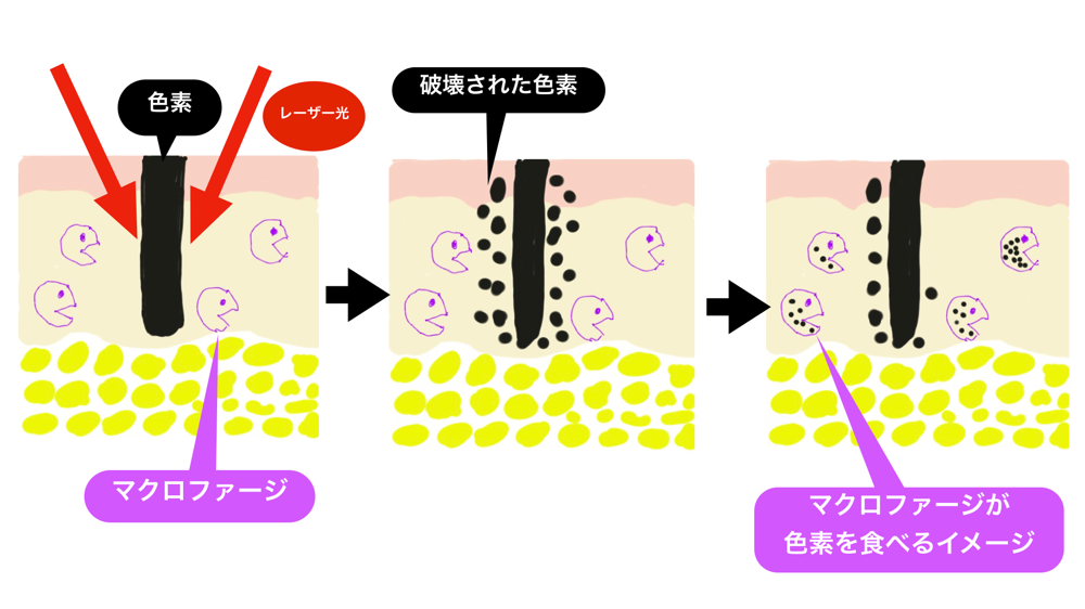 タトゥーによるレーザー除去法のイメージ図