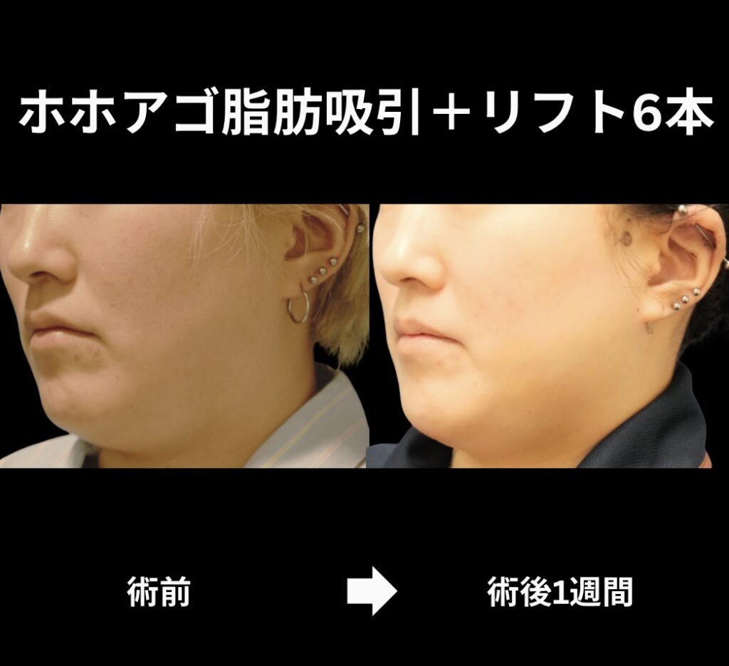 サクションリフトの症例写真
