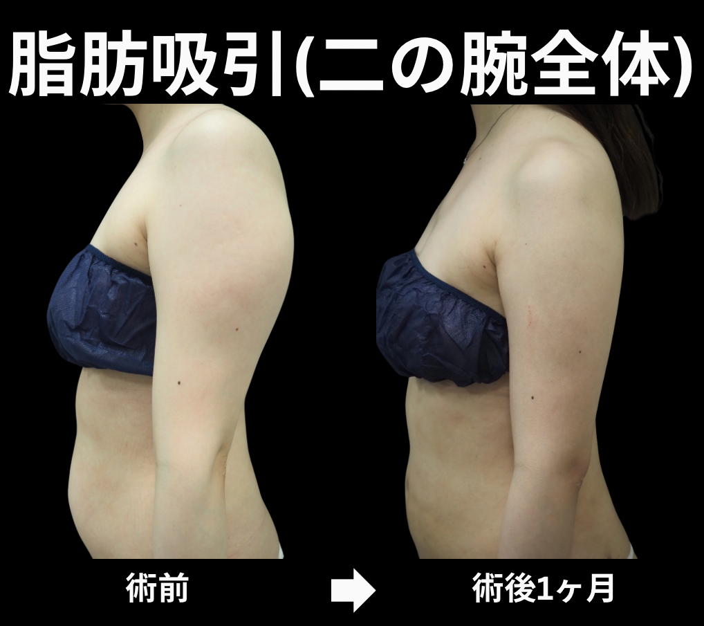 二の腕全体の脂肪吸引