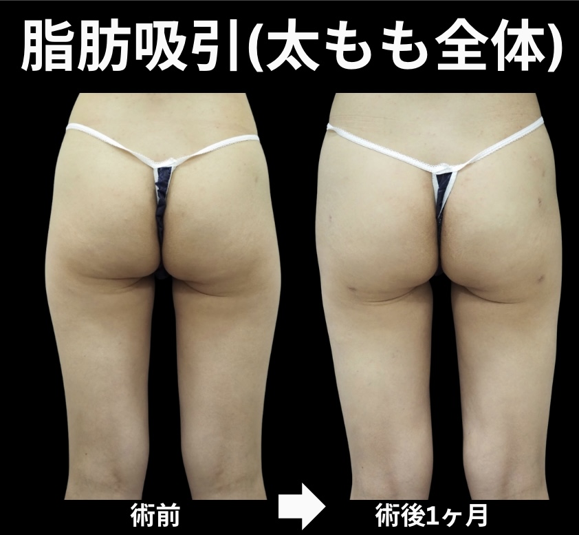 太もも脂肪吸引症例写真