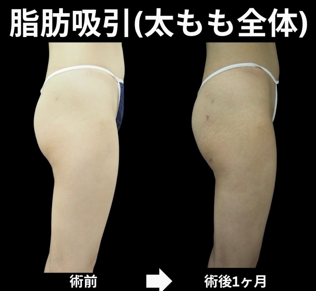 太もも脂肪吸引症例写真
