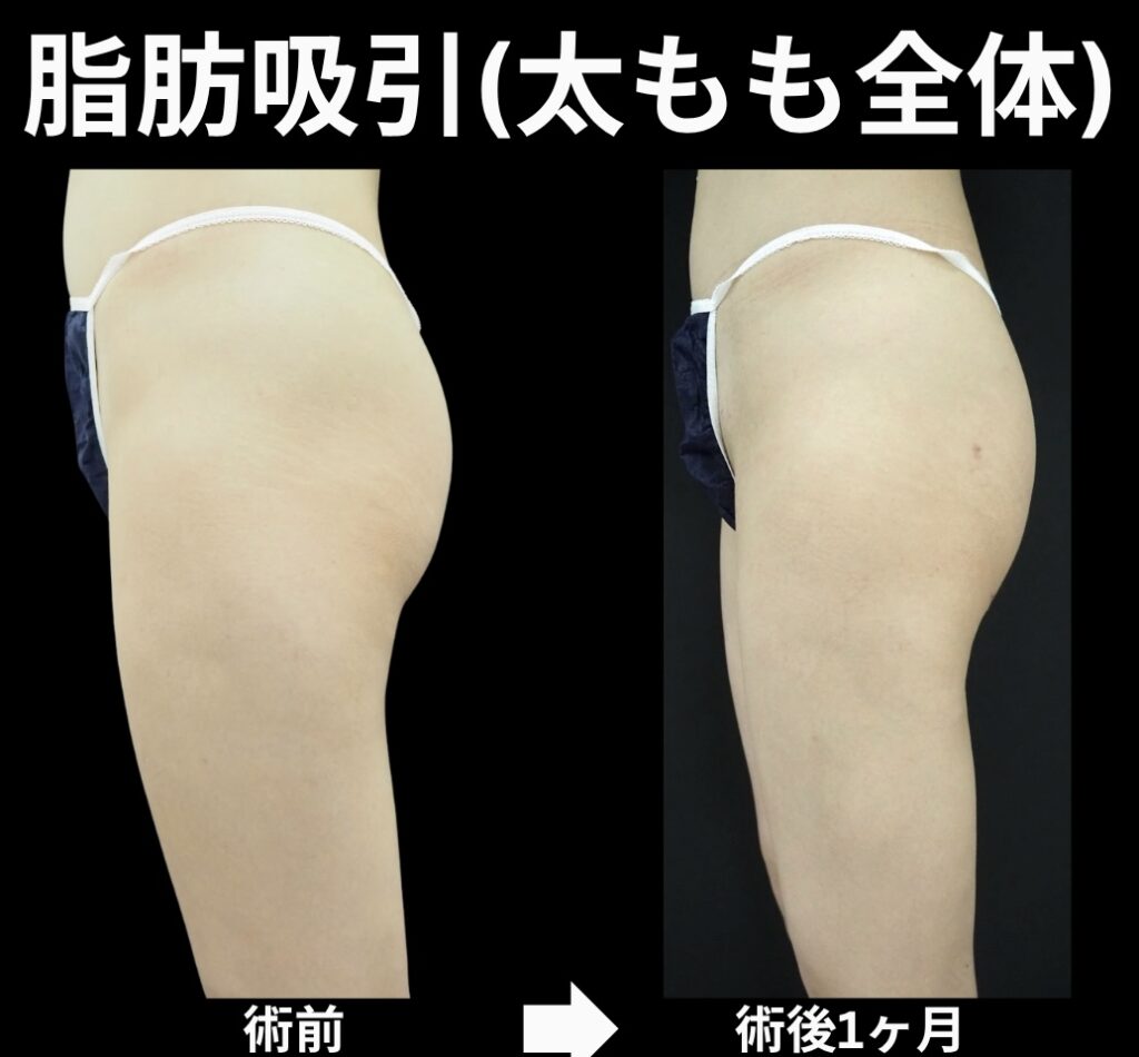 太もも脂肪吸引症例写真