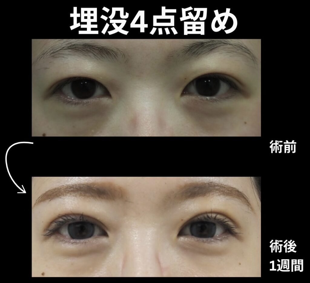 埋没法4点留めの症例写真