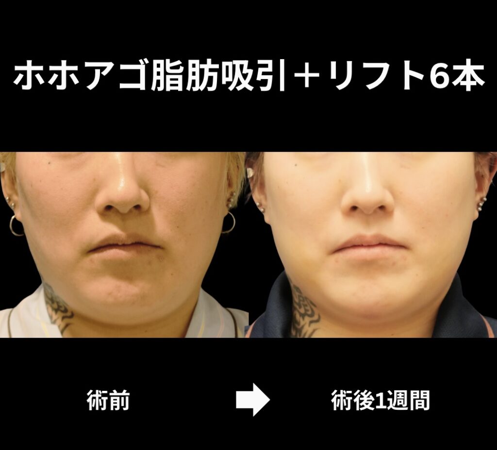 サクションリフトの症例写真