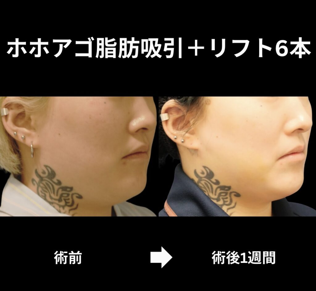 サクションリフトの症例写真
