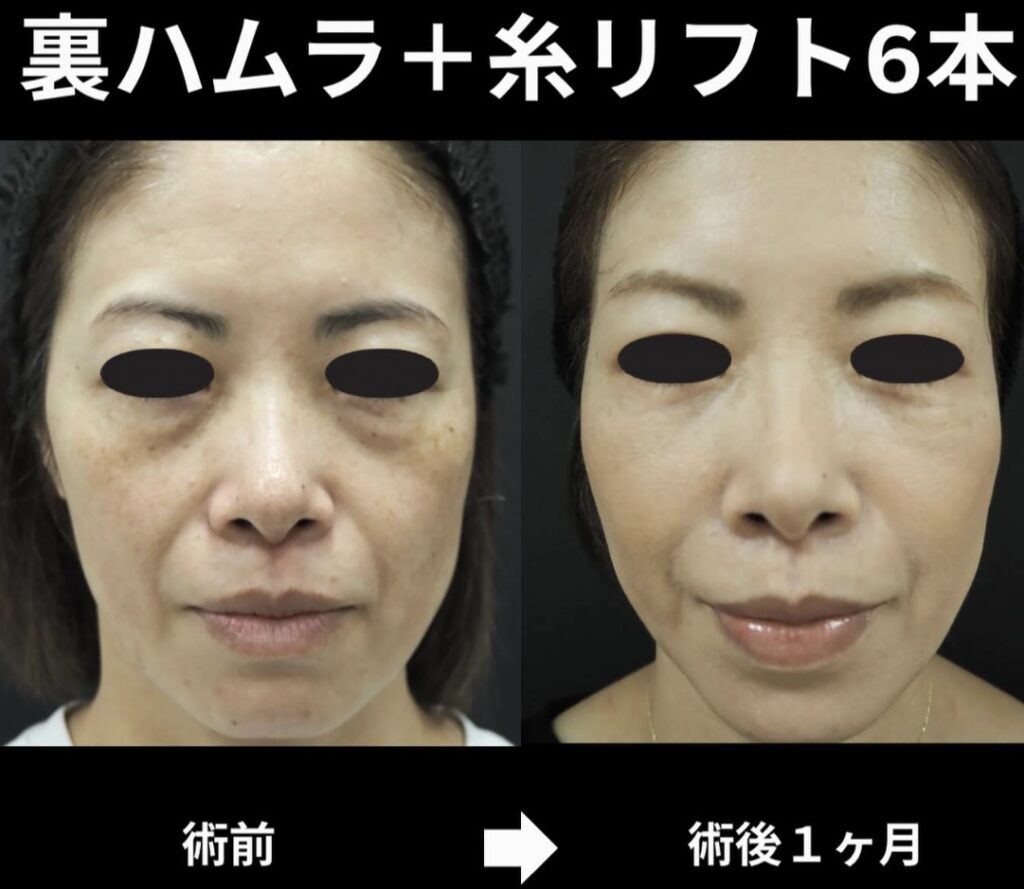裏ハムラ、糸リフト6本