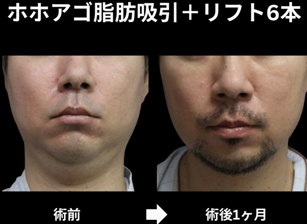 サクションリフトの症例写真