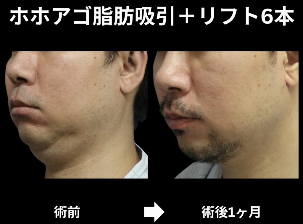 サクションリフトの症例写真