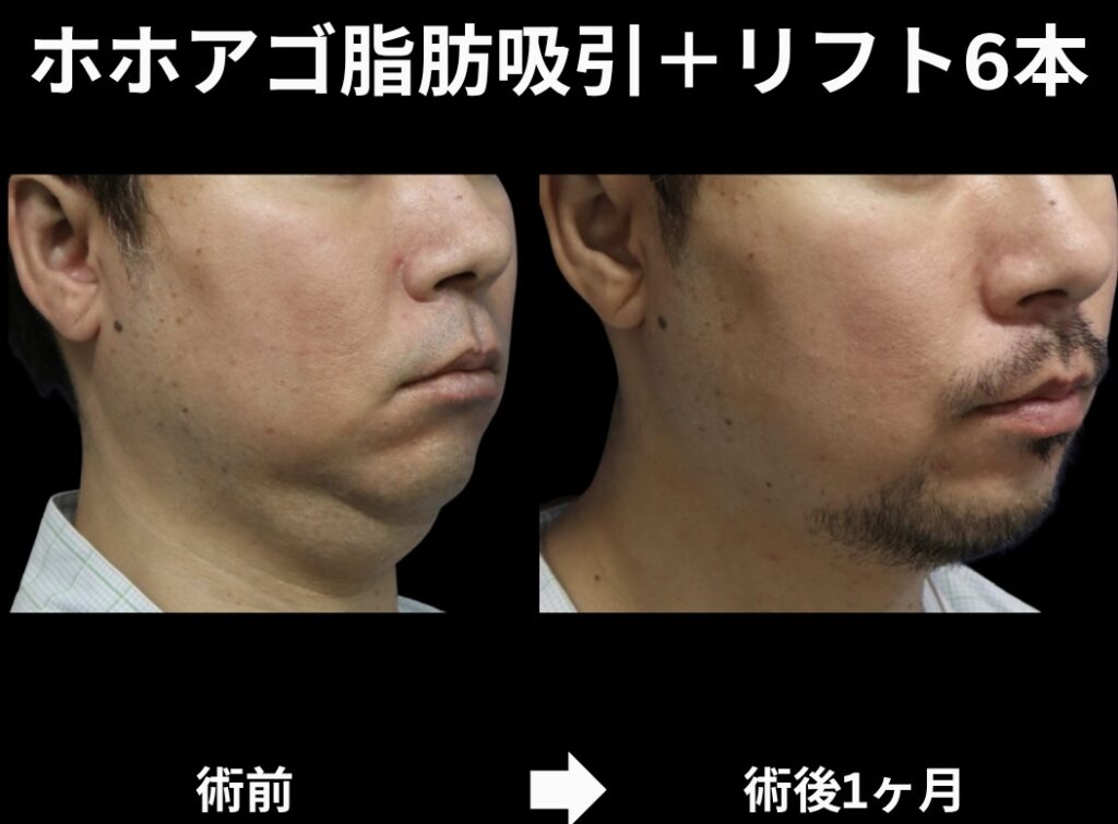サクションリフトの症例写真