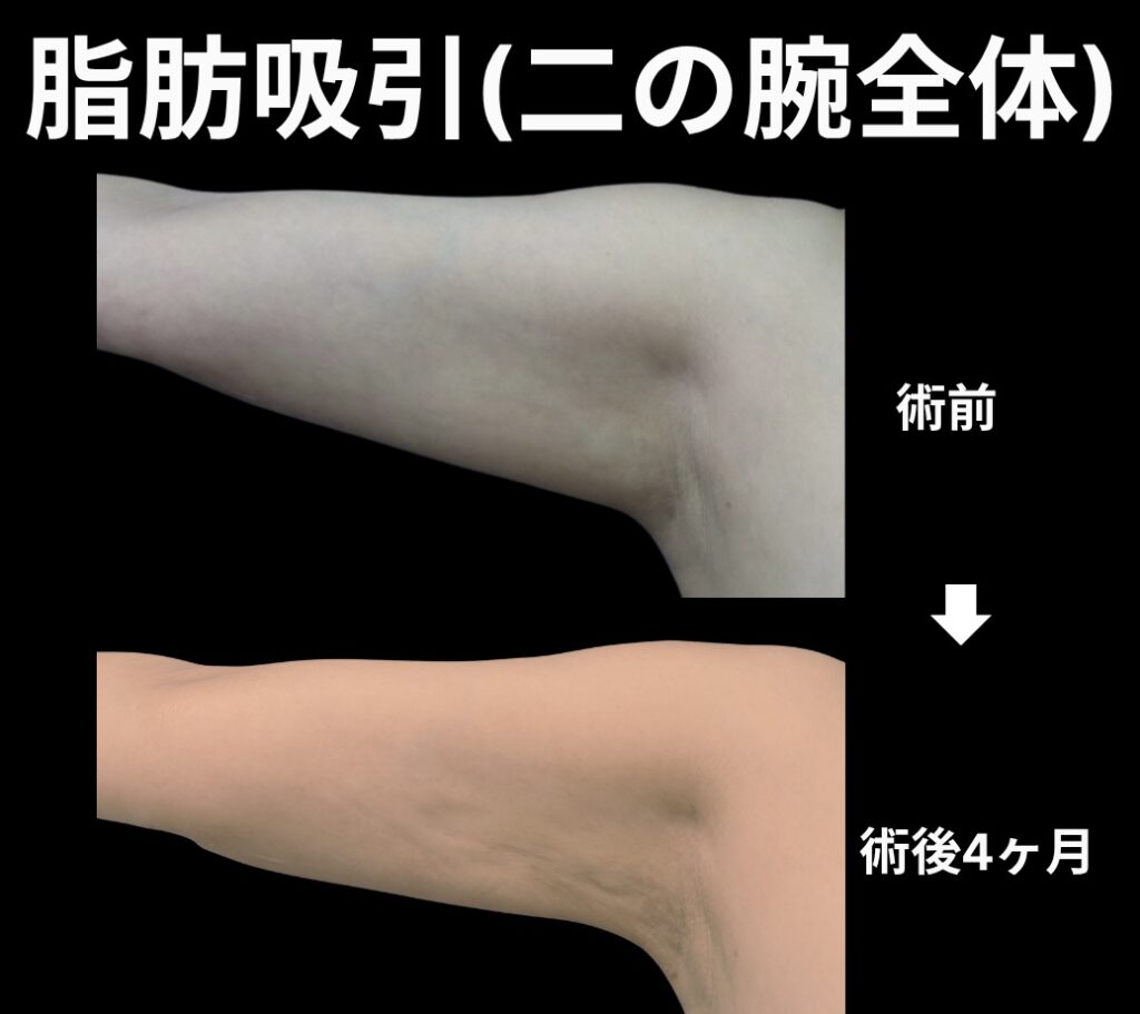 二の腕の脂肪吸引症例