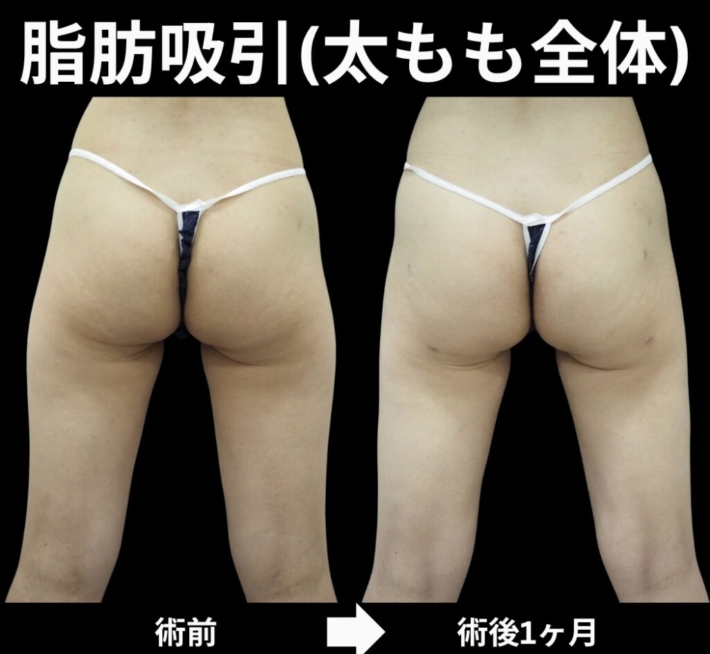 太もも脂肪吸引症例写真