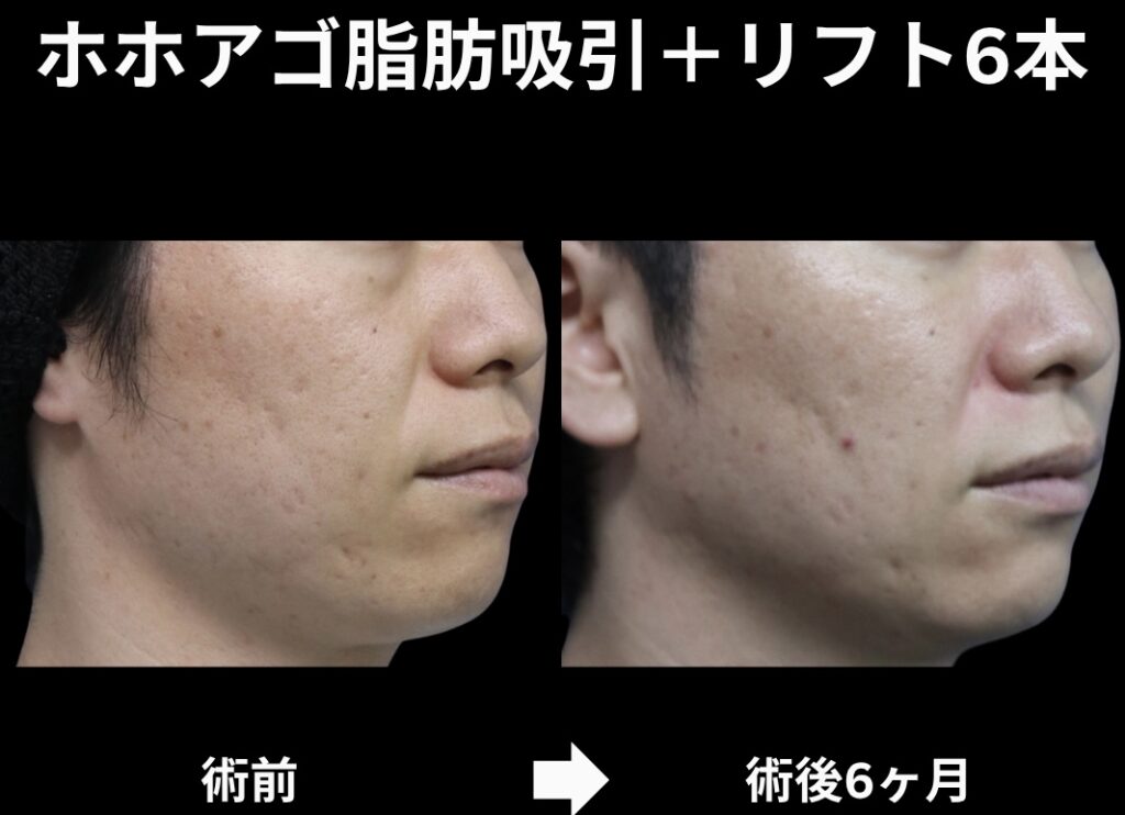 サクションリフトの症例写真