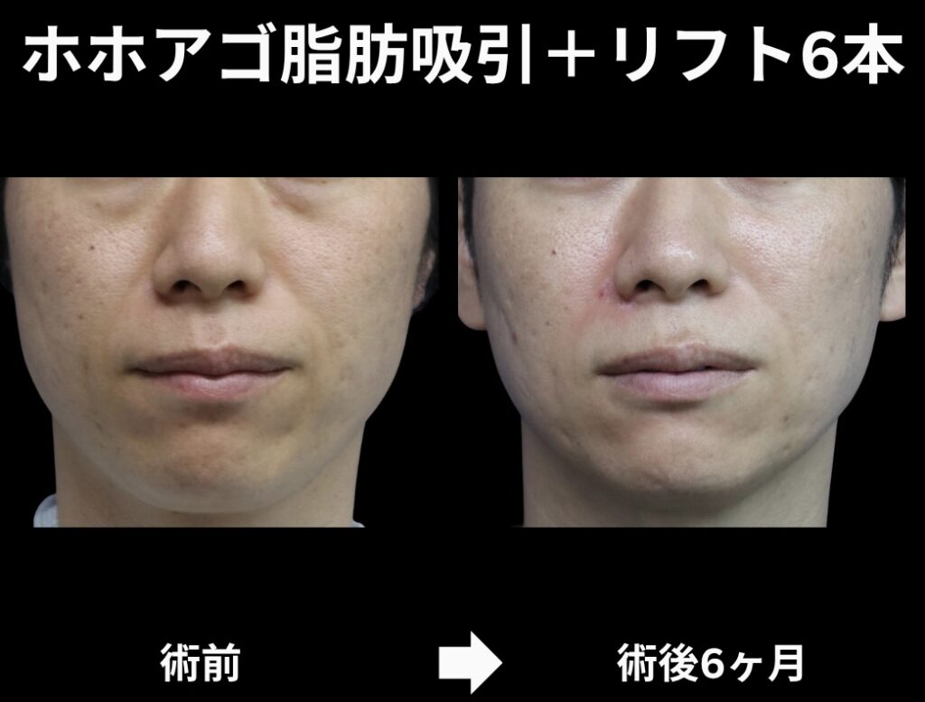 サクションリフトの症例写真