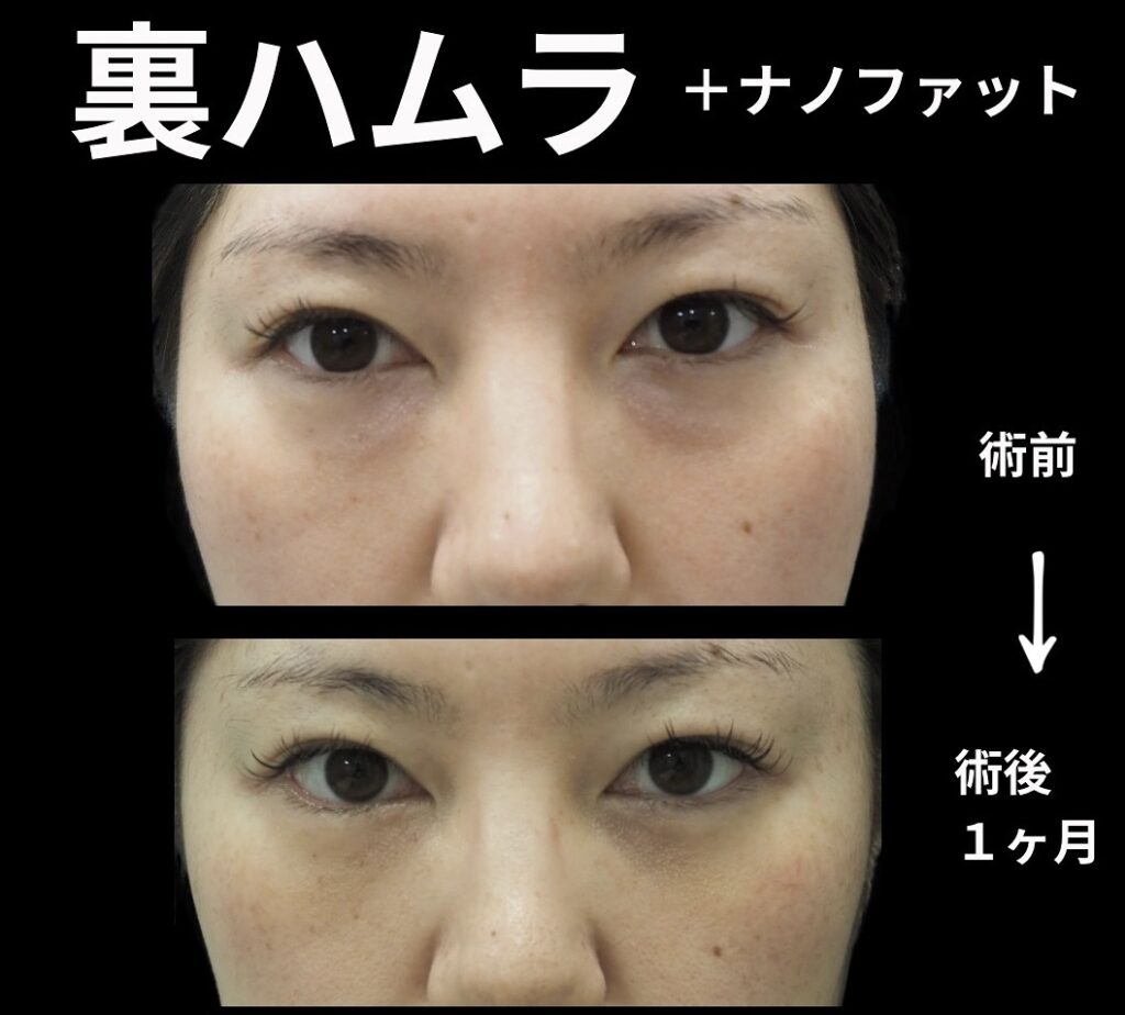 裏ハムラの症例写真