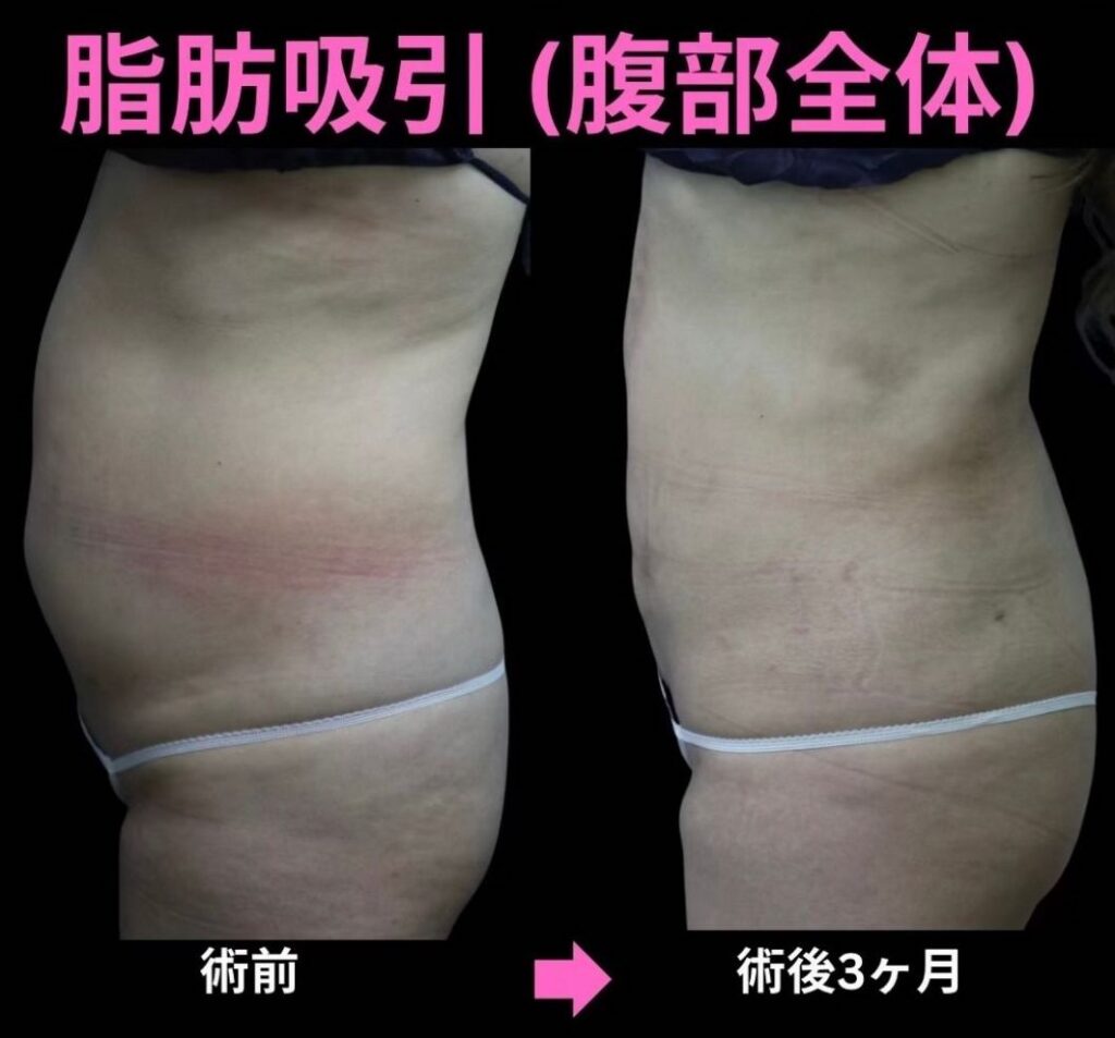 20代女性・腹部全体の脂肪吸引