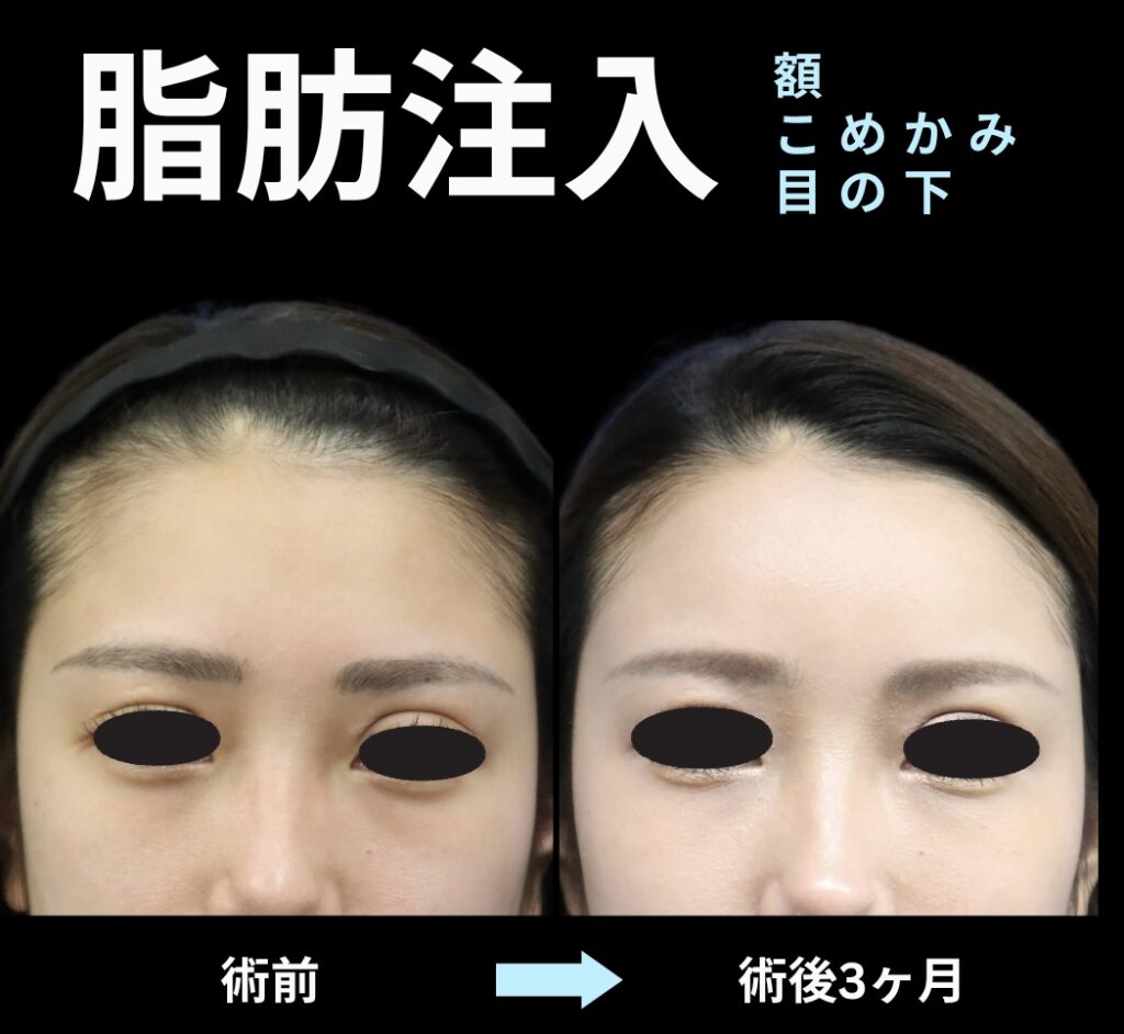 脂肪注入(額・こめかみ・目の下)
