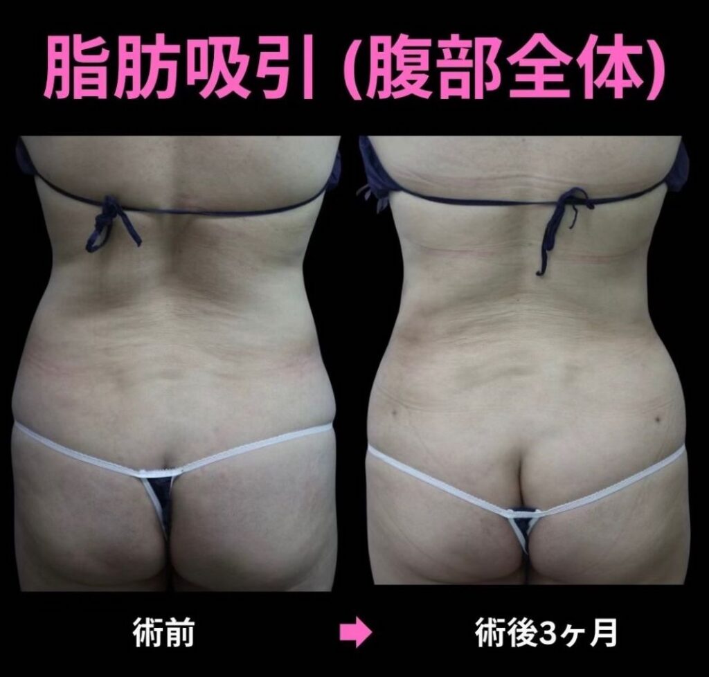 20代女性・腹部全体の脂肪吸引
