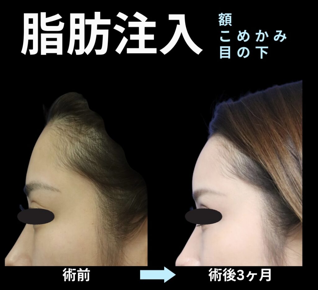 脂肪注入(額・こめかみ・目の下)