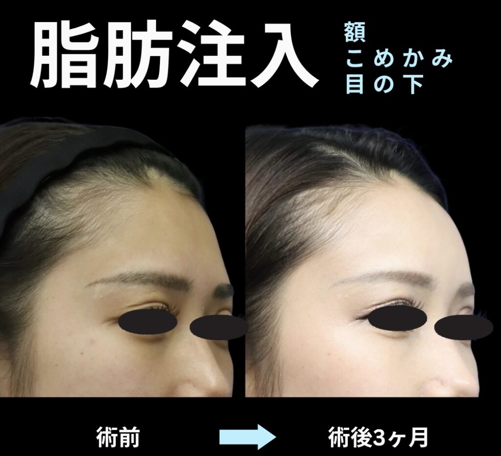 脂肪注入(額・こめかみ・目の下)