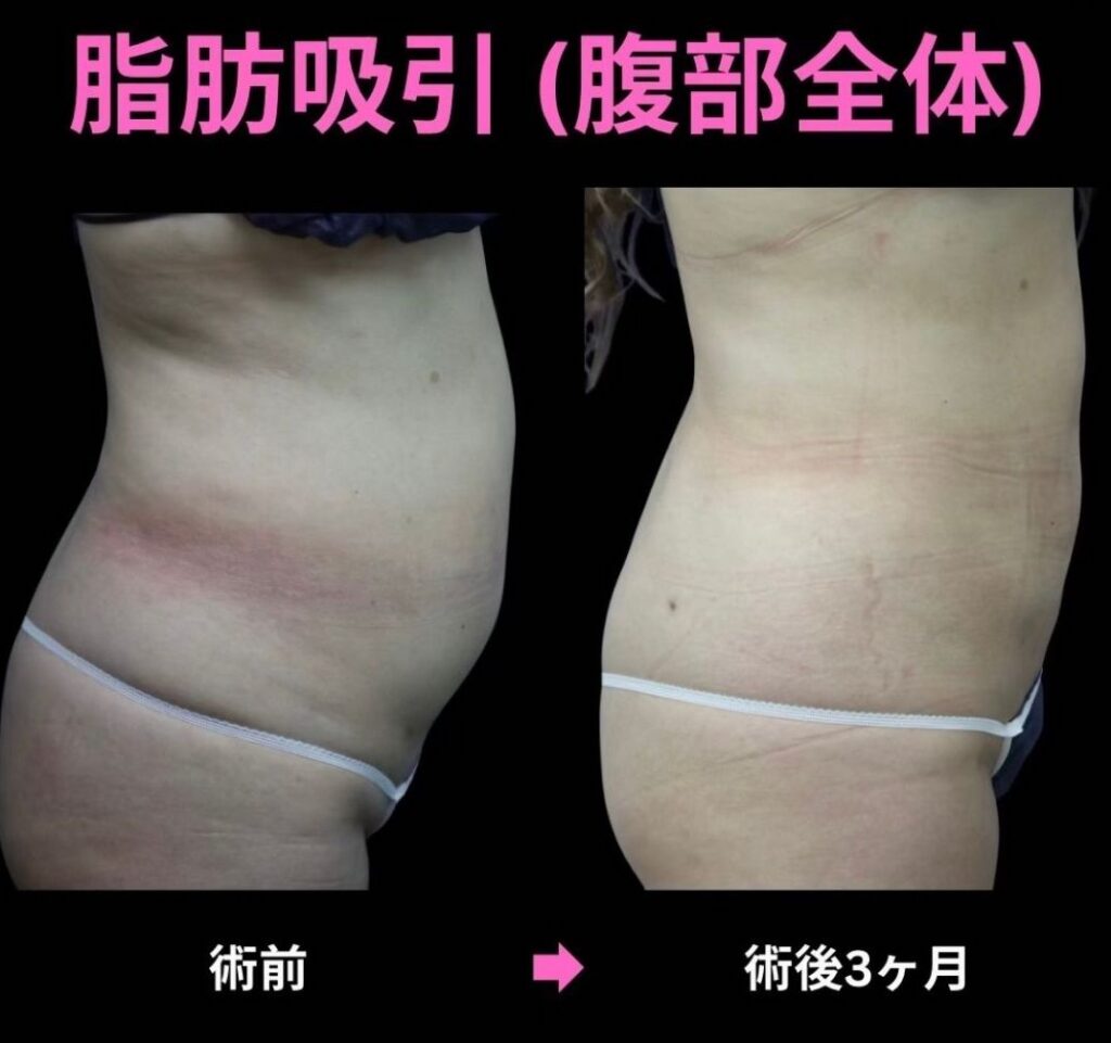 20代女性・腹部全体の脂肪吸引