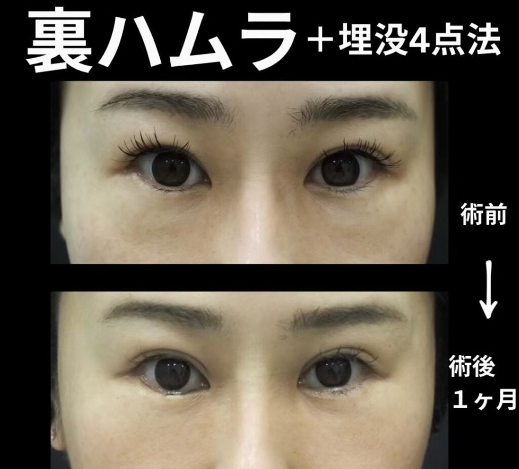 裏ハムラと埋没4点法の症例写真