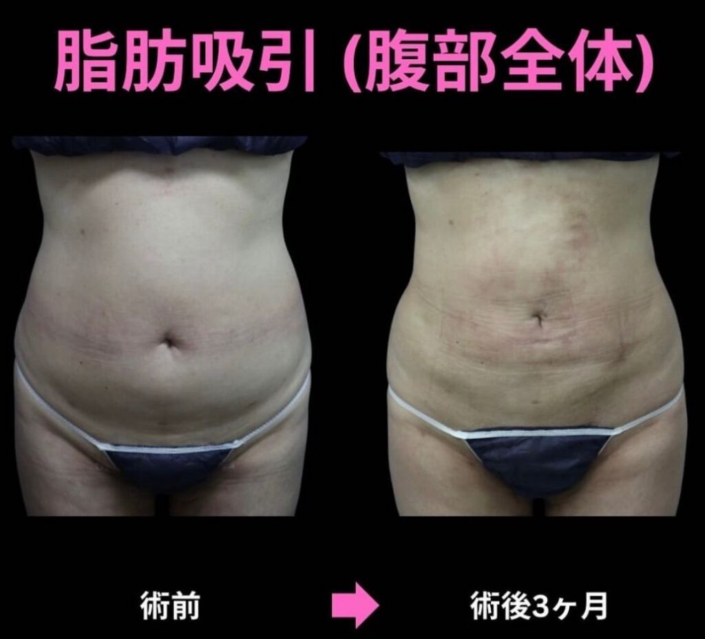 20代女性。腹部全体の脂肪吸引