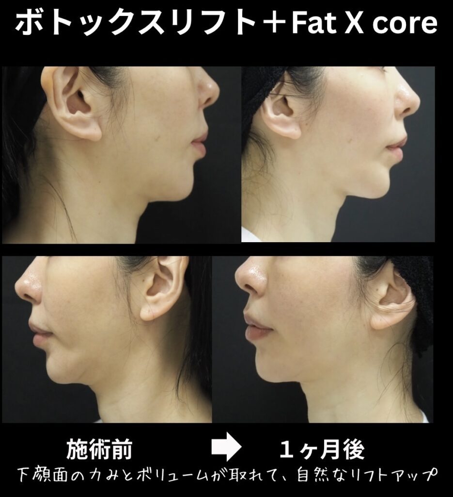 ボトックスリフト、脂肪溶解注射(Fat X core)