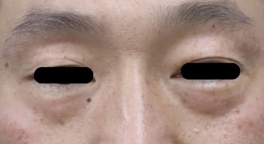目の下膨らみが目立っている、男性の写真