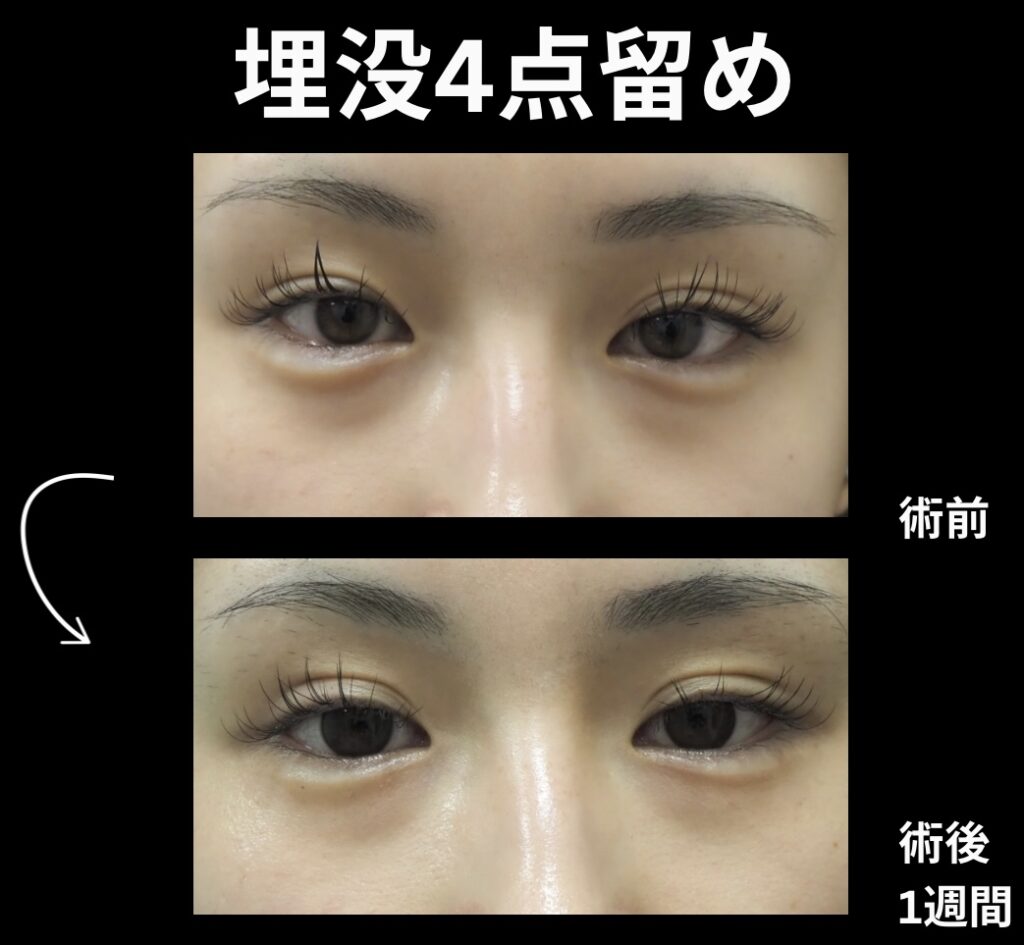 埋没法4点留めの症例写真