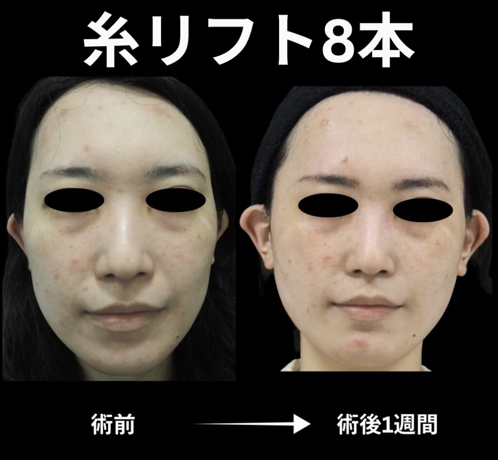 糸リフト8本