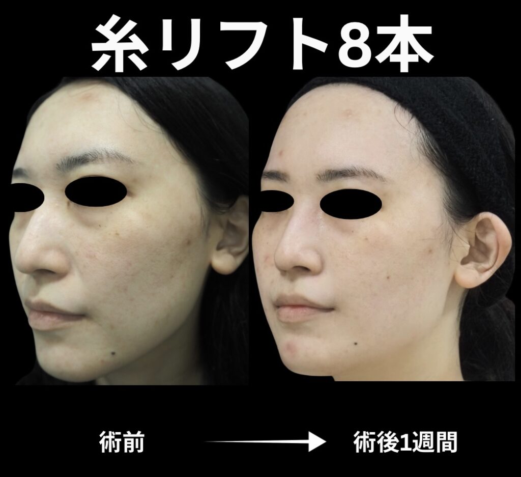 糸リフト8本