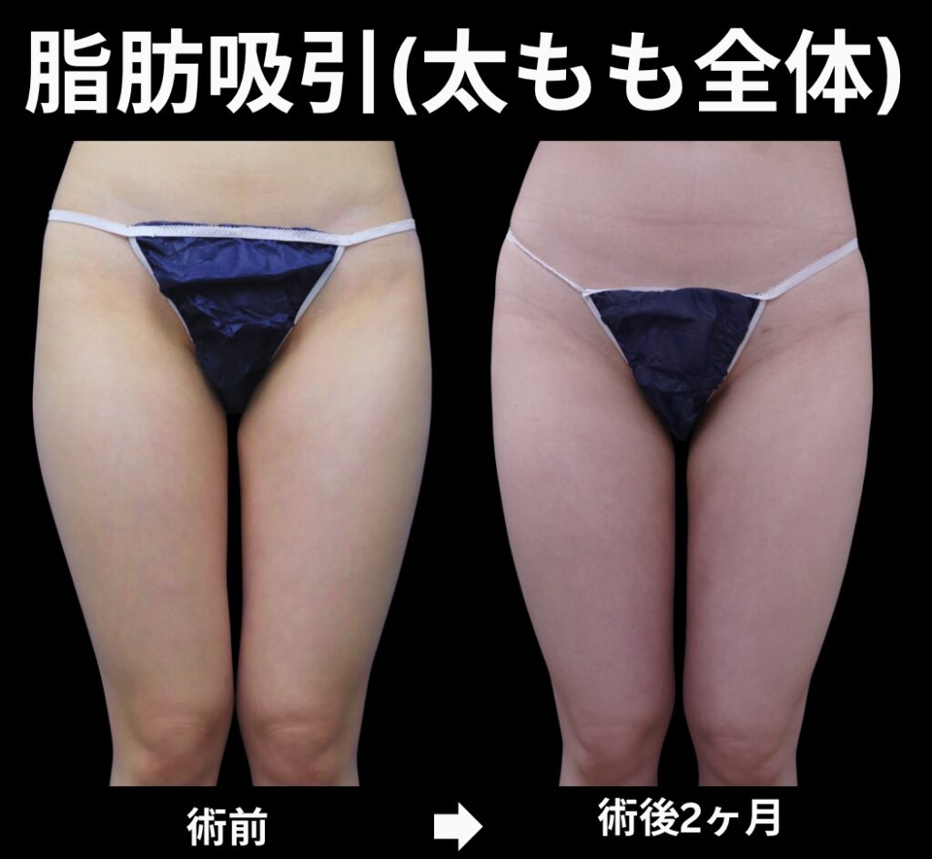 太もも全体の脂肪吸引症例写真