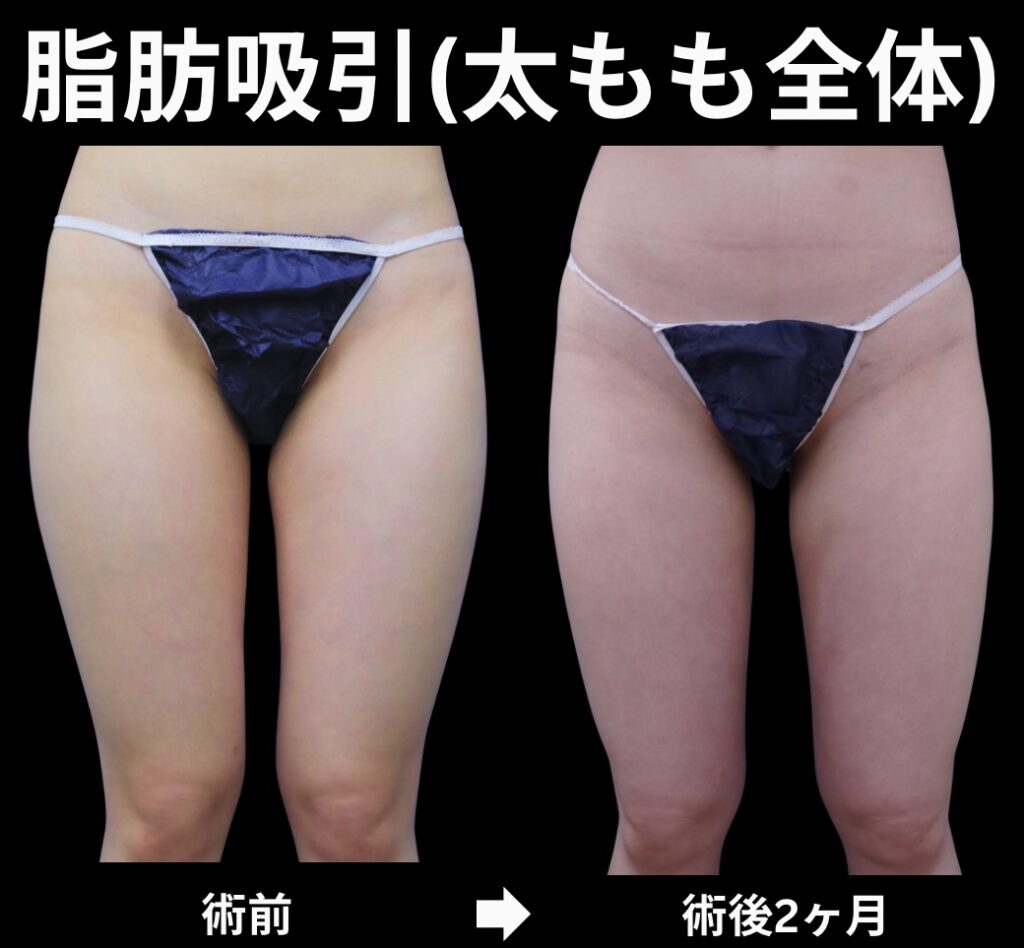 太もも全体の脂肪吸引症例写真