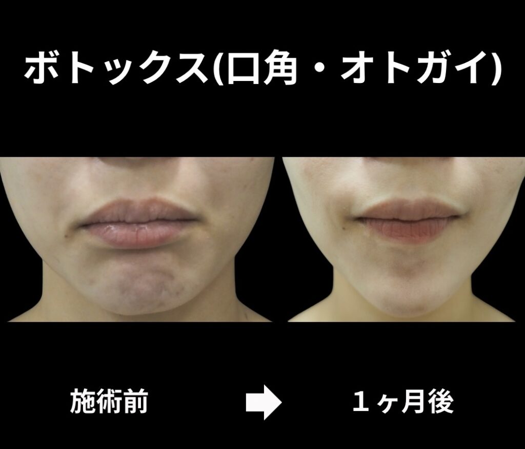 ボトックスの症例写真