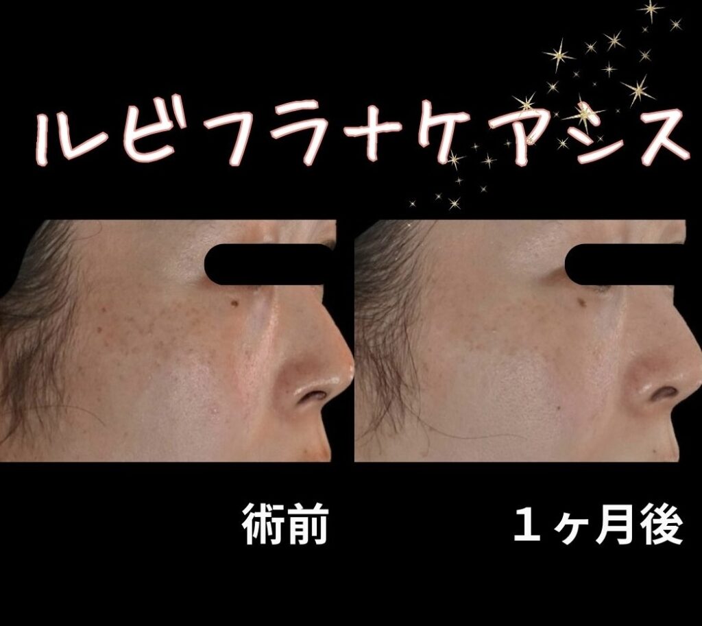 ルビーフラクショナル+ケアシスの症例写真