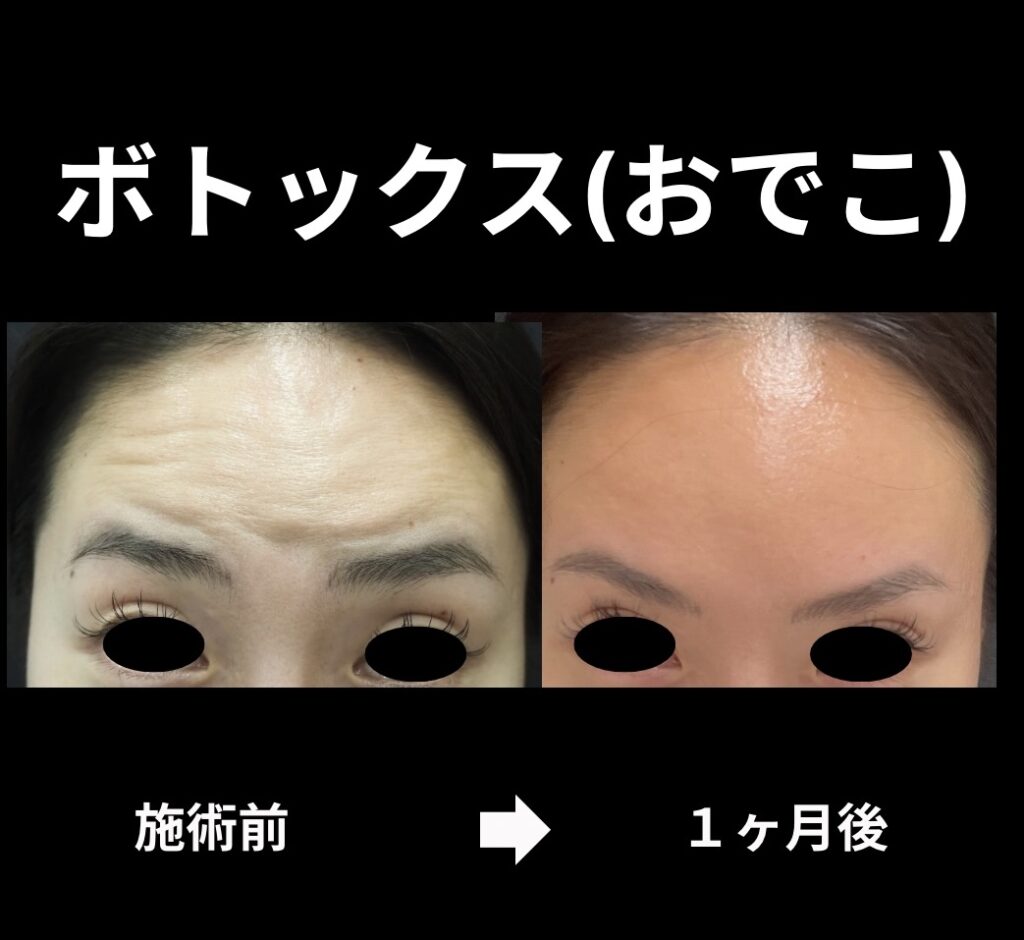 ボトックス(おでこ)の症例写真