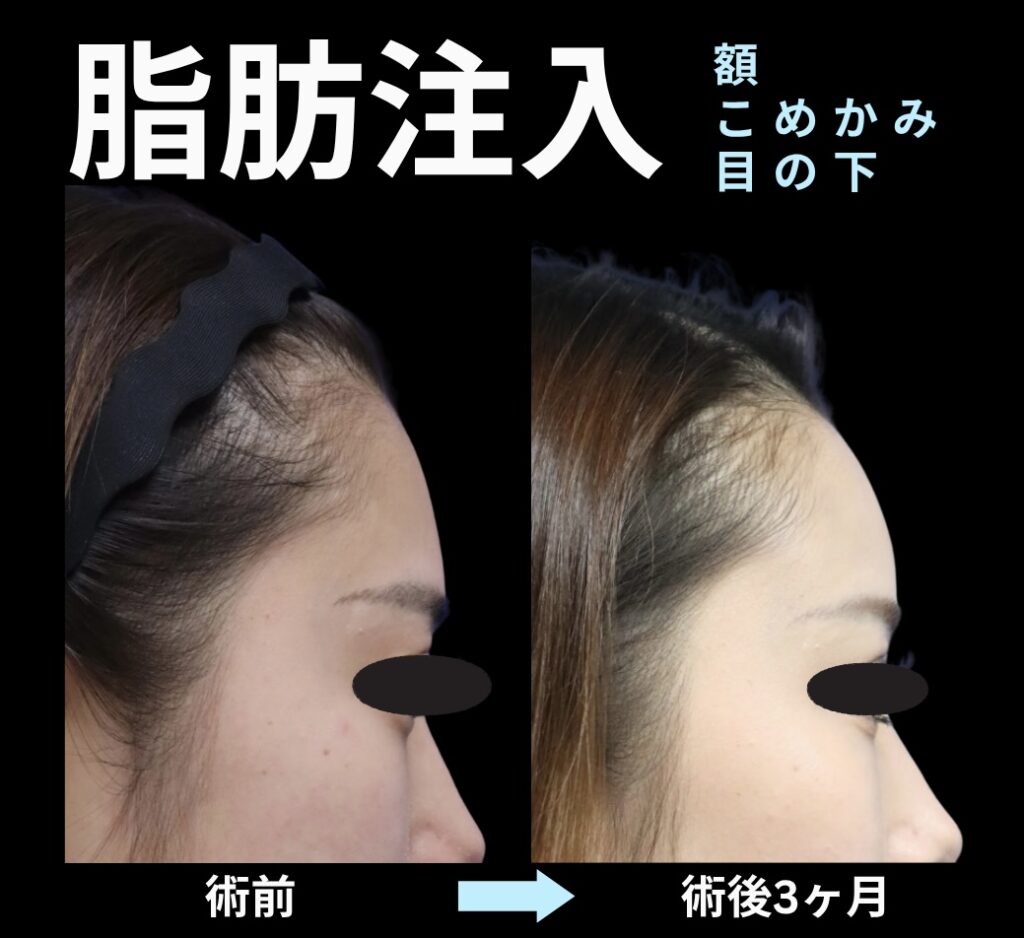 脂肪注入(額・こめかみ・目の下)