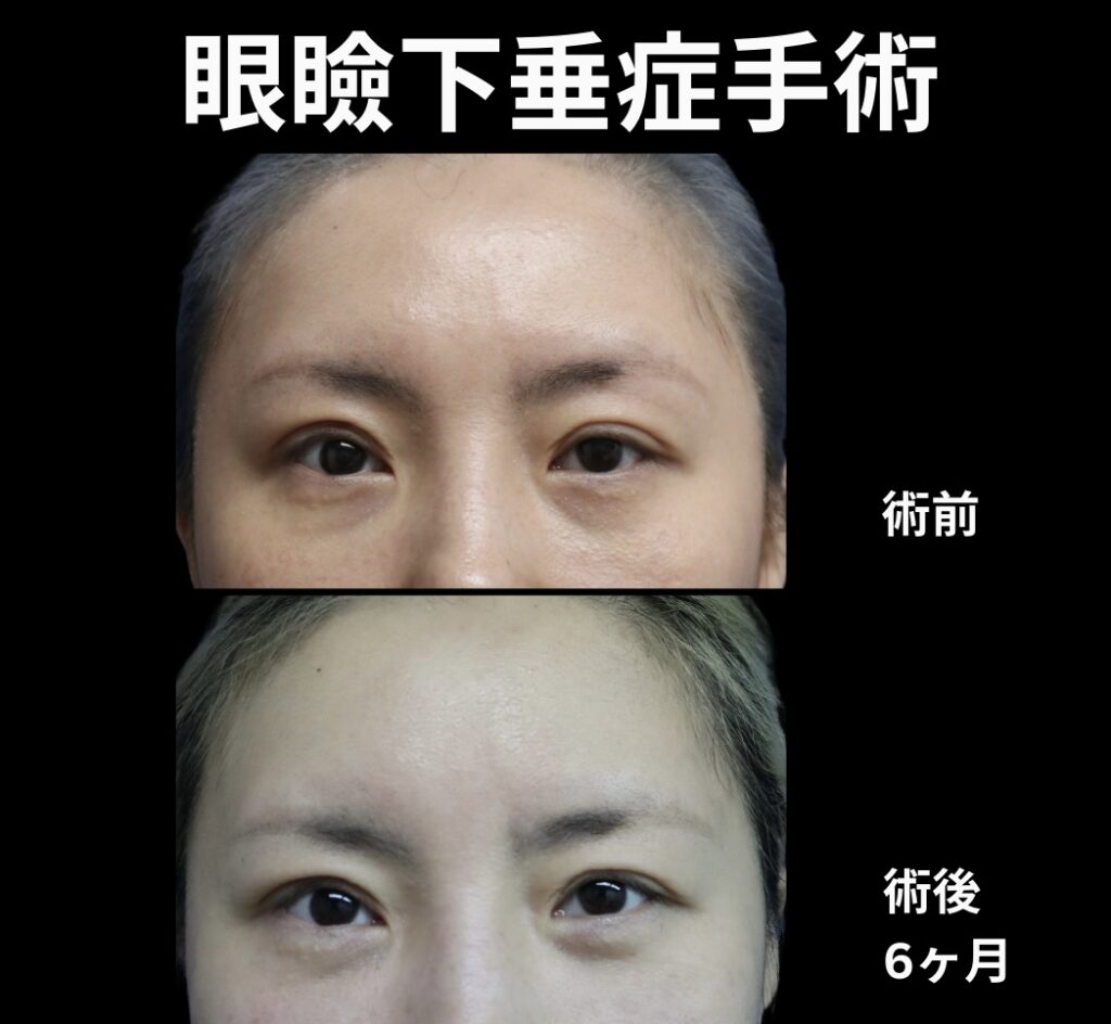 眼瞼下垂症の症例写真