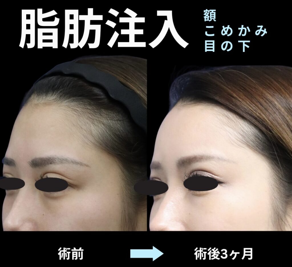 脂肪注入(額・こめかみ・目の下)