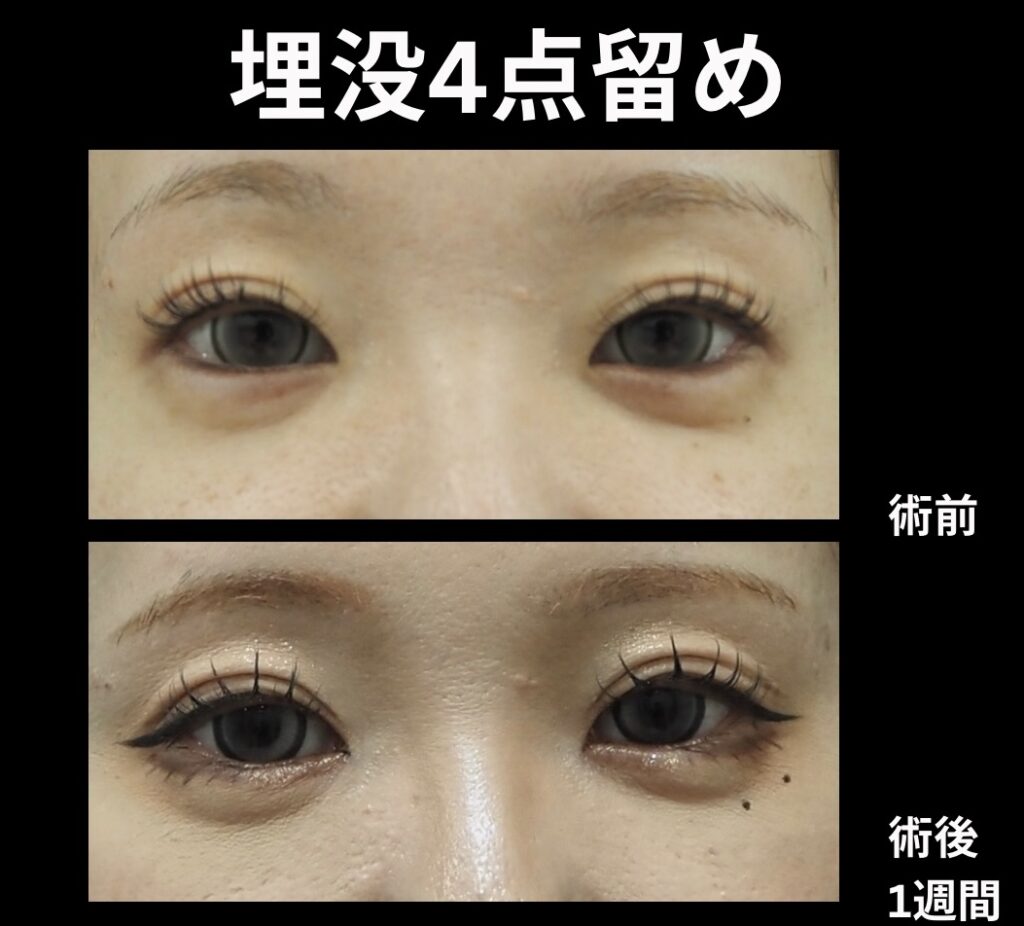 埋没4点法の症例写真