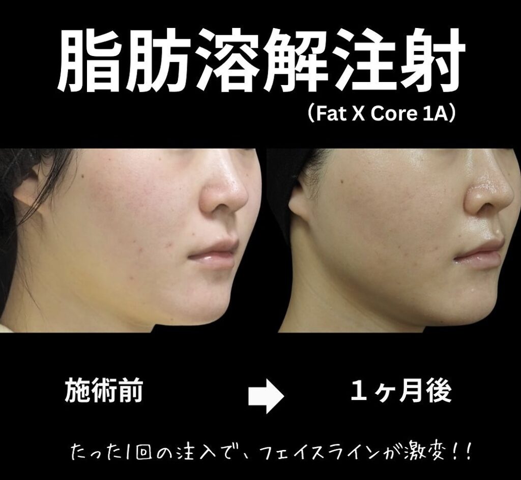 脂肪溶解注射の症例写真