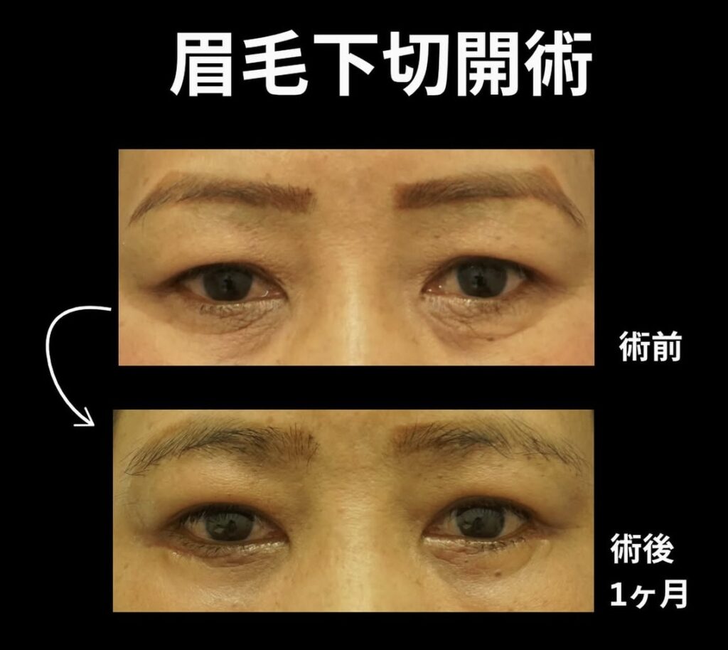 眉毛下切開術の症例写真