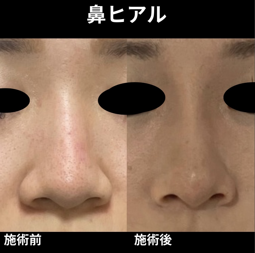 鼻ヒアルロン酸注入の症例